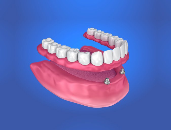 Aiken Dentures
