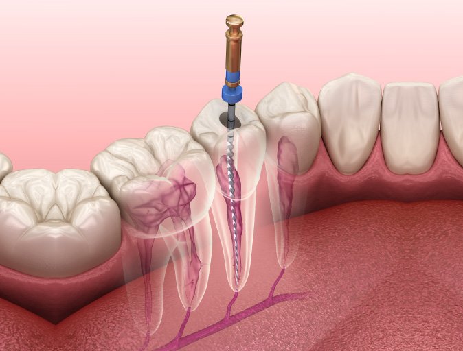 Aiken Root Canals