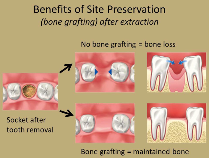 Socket Preservation